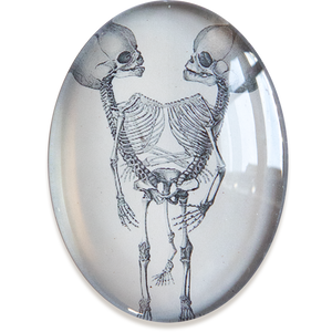 Conjoined Twins Anatomical Oddities Glass Cameo Cabochon
